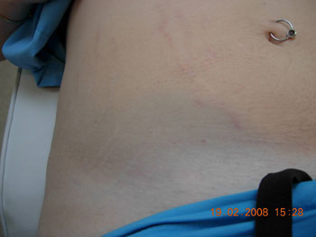 carboxy stretch mark therapy long island great neck